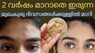 In just a few Days Remove pimples amp dark spots in Malayalamകളിയാക്കുന്നത് കേട്ട് മടുത്തു 🥺 [upl. by Kidd]