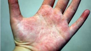 DermTV  How to Treat Eczema DermTVcom Epi 178 [upl. by Adnol]