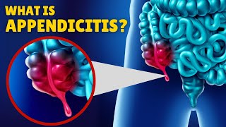 Appendicitis – Causes Signs and Symptoms Diagnosis amp Treatment [upl. by Leonid]