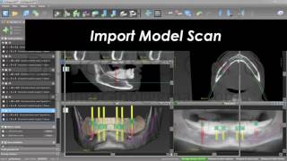 coDIagnostiX for Edentulous Patients Single CBCT and Retention Pins [upl. by Nahtnaoj]