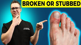 Stubbed Toe or Broken Toe Symptoms Pain Relief amp Treatment [upl. by Nagram]