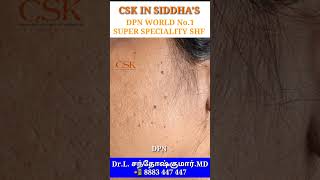 முகத்தில் மட்சம் மா   DPN கருப்பு புள்ளி  Dermatosis papulosa nigra [upl. by Skrap]