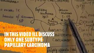 Thyroid carcinoma  papillary carcinoma [upl. by Marcelline]