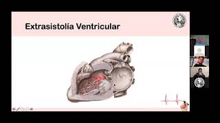10 Fibrilación Auricular Flutter y Extrasístoles Dr Christian Karmelic 2021 [upl. by Langelo]