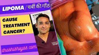 Lipoma चर्बी की गाँठ कैंसर् बन सकती है malignant दर्द क्यों size कब बढ़ता है Liposuction [upl. by Gipsy]