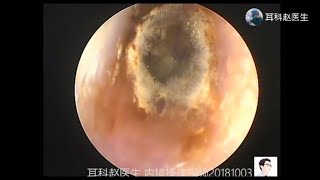 Treatment of fungal otitis externa by ear endoscope for 12 minutes 耳内镜处理真菌性外耳道炎，12分钟 [upl. by Maitland]