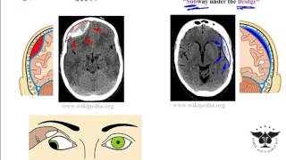 Hemorrhagic stroke epidural amp subdural hematoma  USMLE Step 1 [upl. by Antoinette]