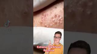 EXTREME BLACKHEAD REMOVAL  Blackhead Popping At Its Best shorts [upl. by Lupee]