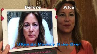 LIQUID FACELIFT  ULTIMATE Dermal Filler MAKEOVER [upl. by Roderick209]