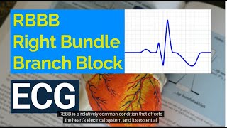 Understanding Right Bundle Branch Block RBBB on ECG Causes Symptoms and Treatment [upl. by Uriiah]