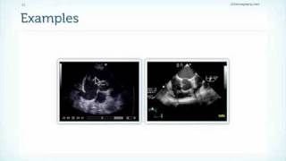 Tricuspid Valve Endocarditis in Echocardiography [upl. by Louanna]