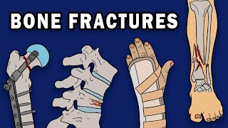 BONE FRACTURES [upl. by Yentuoc50]