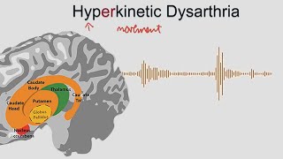 Hyperkinetic Dysarthria  samples and explanation [upl. by Nielsen654]