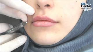 حقن الشفاه بالفيلر  دعامر قنباز  DrAmer Kunbaz  Lip Augmentation  Filler injection [upl. by Nyral]