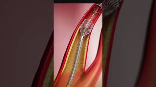 ANGIOPLASTY PROCEDURE ANIMATED [upl. by Cyna939]