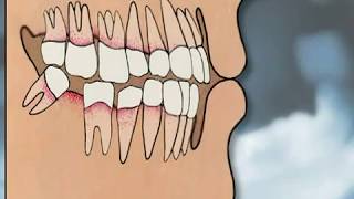 Dental Implants Pros amp Cons  YOU MUST SEE IT [upl. by Jo]