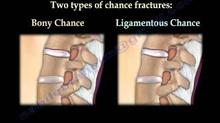 Chance Fractures of the Spine  Everything You Need To Know  Dr Nabil Ebraheim [upl. by Durward]