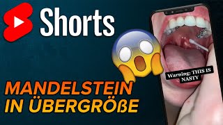 Mandelstein selber entfernen 20 shorts [upl. by Chavez320]