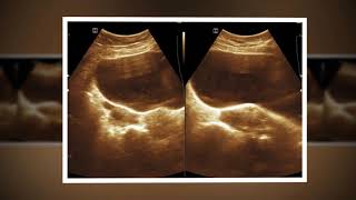 Ultrasound cases 438 of 2000  Debris in Urinary Bladder Fatty Liver Myoma Right Adnexal Cyst [upl. by Florian355]