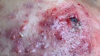 CYSTIC ACNE REMOVAL  Inflammatory Acne Acne Skin Treatment [upl. by Earvin]