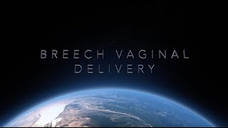 Breech Vaginal Delivery [upl. by Omari212]