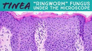 quotRingwormquot under the microscope tinea dermatophytosis fungal folliculitis Majocchi pathology [upl. by Eendys]