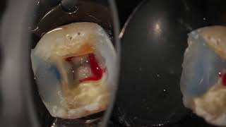 Complete endodontic treatment of a lower first molar step by step [upl. by Ranit]