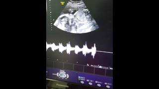 Baby heart beat sound in womb ultrasound scanning 23 weeks kaurwaki [upl. by Olpe694]