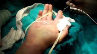 Flexor Tendon Sheath WashoutMOV [upl. by Holder]