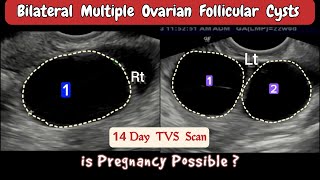 TVS Ultrasound  Bilateral multiple Ovarian Follicular Cysts [upl. by Bithia]