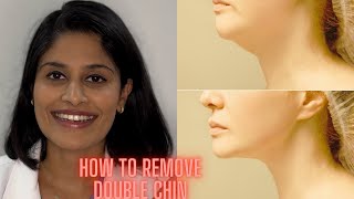 Double chin treatment in Hyderabad Telugu [upl. by Ydnik]