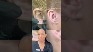 Earlobe repair before amp after at Dr Medispa [upl. by Ardnaek326]