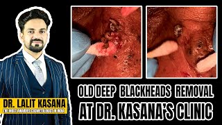 OLD DEEP BLACKHEADS REMOVAL AT DRKASANAS CLINIC [upl. by Marietta]