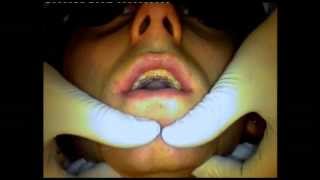 Embarrassing Bodies Dentist  Severe Tooth Wear [upl. by Blunt]