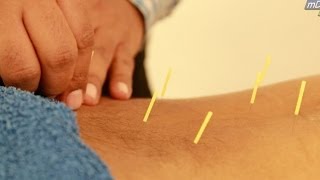 HINDI Acupuncture Treatment Demo [upl. by Birk]