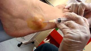 Video  recurrent ganglion aspiration [upl. by Monte605]