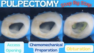 Pulpectomy ⚪️ Step By Step Demonstration 🔵 Baby Blue Pediatric Rotary Endodontic Files [upl. by Noel]