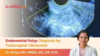 Endometrial Polyp Diagnosis by Transvaginal Ultrasound  Dr Shilpa G B [upl. by Melisse]