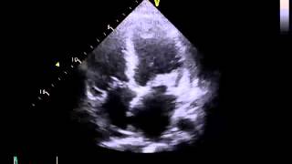 Echocardiography to Assess MitralValve Leaflets  NEJM [upl. by Elinnet]