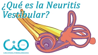 ¿Neuritis vestibular ¿Vértigo  Otorrinos CIO Bilbao [upl. by Ostler399]