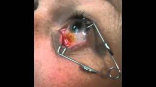 Eye Injection Procedure [upl. by Sedgewake451]