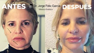 HILOS TENSORES ANTES Y DESPUÉS HILOS TENSORES FACIAL ANTES Y DESPUÉS DOCTOR JORGE FÉLIX GARCÍA [upl. by Anirtruc]