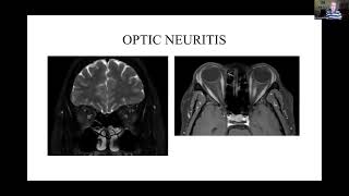 Neurosarcoidosis Presentation – Neurosarcoidosis Patient Day 2022 [upl. by Yelsek]