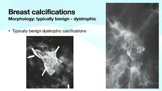 Breast Calcifications Part 1  Free Radiology CME [upl. by Isleen]