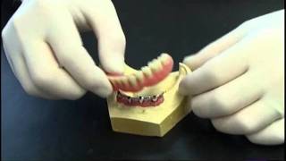 Prothese clipsee sur implant avec barre [upl. by Terra]