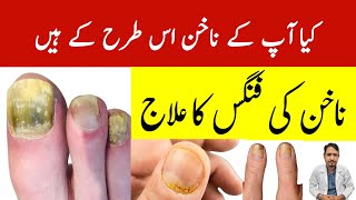 Nail Fungus Treatment Urdu Hindi  Irfan Azeem [upl. by Kashden]