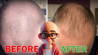 5 Early Signs You’re Going Bald 😱  Don’t Ignore These Warning Signs 🚨👨‍🦲 [upl. by Man]