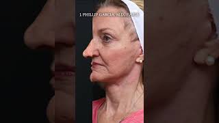 Facelift Transformation [upl. by Okihcim]