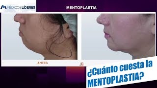 Mentoplastia  Precio Exacto en 2018 Fotos de Antes y Después  Cirugia del Mentón [upl. by Annodal]