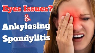 How is Ankylosing Spondylitis Affecting the Eyes [upl. by Sauers]